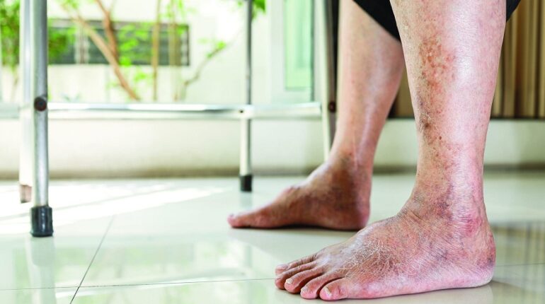 diabetic ulcer wound care