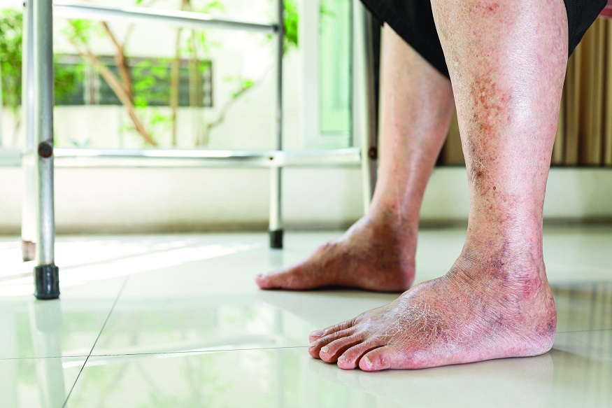 diabetic ulcer wound care